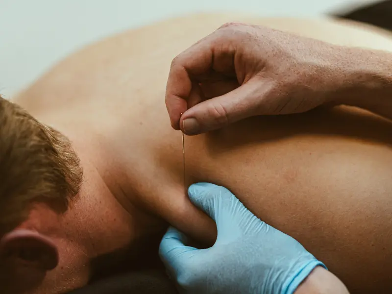 Dry needle Alkmaar